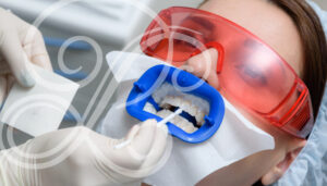 Professional tooth whitening is best.